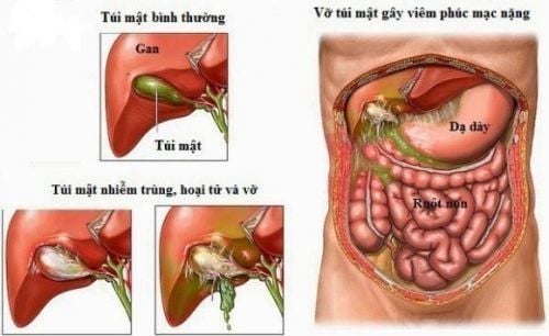 
Viêm phúc mạc toàn bộ
