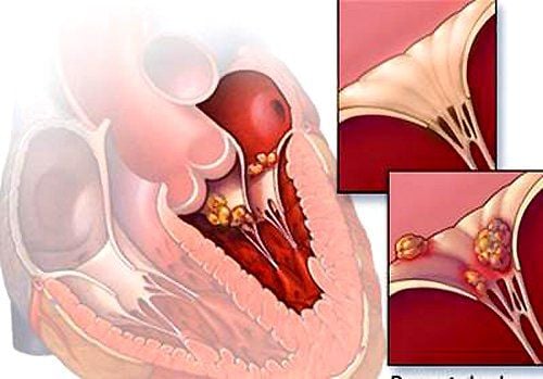 
Người mắc bệnh thấp tim có nguy cơ gây hở van 2 lá
