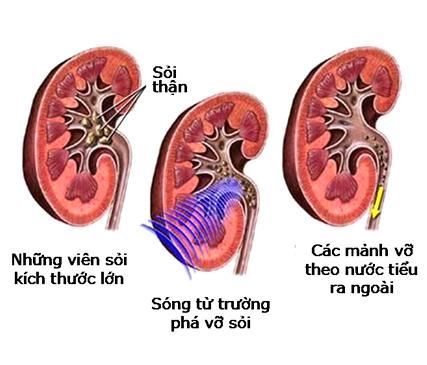 
Tán sỏi ngoài cơ thể
