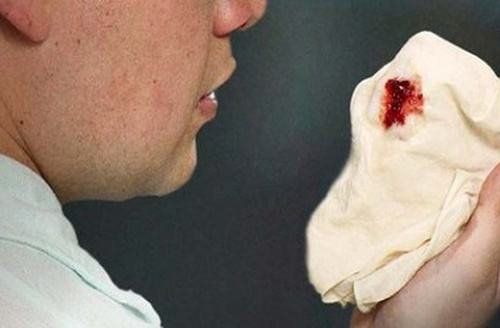 Coughing up blood: Don't take it lightly