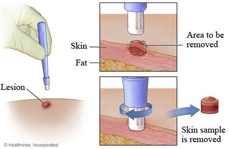 
Sinh thiết da là thủ thuật lấy một mảnh da có kích thước khoảng từ 2 đến 5mm để xét nghiệm mô bệnh học
