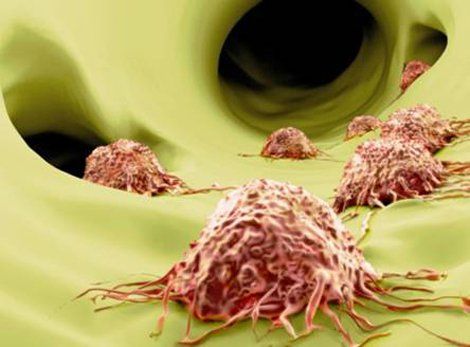 What does metastatic cancer mean?