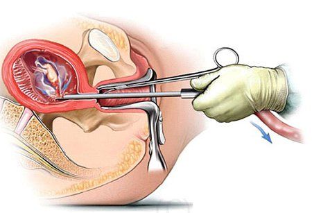 
Trong phương pháp hút thai chân không, bác sĩ sẽ sử dụng dùng ống hút chân không chuyên dụng để hút thai ra ngoài
