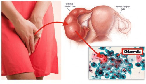 
Chlamydia là bệnh lây truyền qua đường tình dục gây nguy hiểm cho thai kỳ
