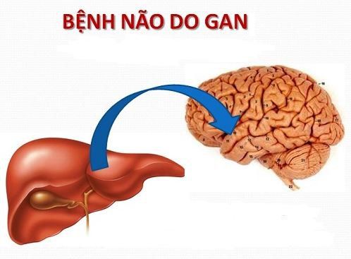 Bệnh lý não gan là gì?