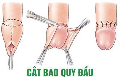 
Kỹ thuật cắt bao quy đầu
