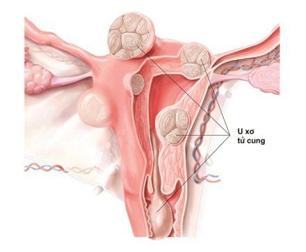 
Khối u có thích thước nhỏ và không có triệu chứng điển hình thì vẫn có thể mang thai bình thường
