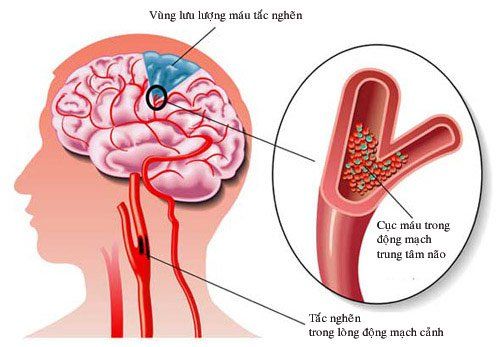 
Thiếu máu não cục bộ làm chóng mặt trung ương
