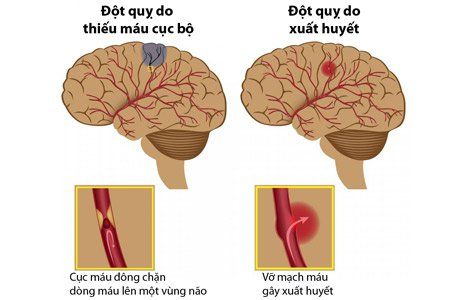 
Tai biến mạch máu não được chia làm hai loại chính là nhồi máu não và xuất huyết não
