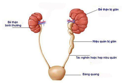 
Sỏi niệu quản kích thước lớn sẽ gây tắc niệu quản
