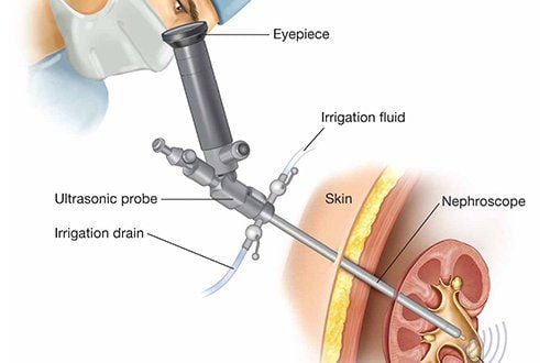 Percutaneous kidney stone lithotripsy: Non-invasive, highly effective