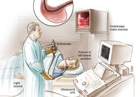 
Nội soi tiêu hóa không đau giúp bệnh nhân thoải mái và không bị đau, nôn ói
