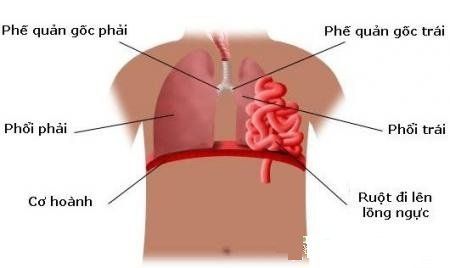 Trauma to the chest caused a rupture of the diaphragm