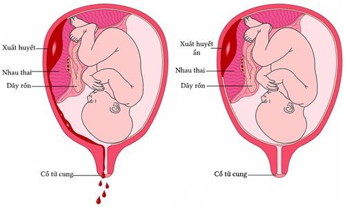 
Nhau bong non do sử dụng Oxytocin
