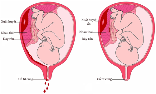 Abortion vegetables - dangerous obstetric complications