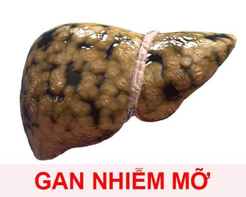 
Gan nhiễm mỡ không do rượu có thể phân ra làm 3 loại
