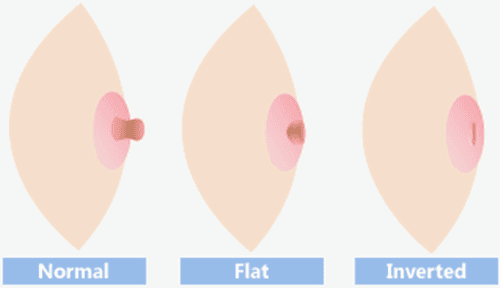 What happens when the nipple is inverted?