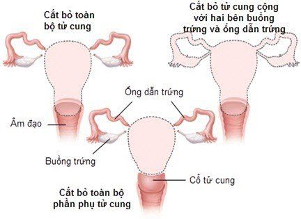 
Cắt tử cung là biện pháp cuối cùng để điều trị đờ tử cung sau đẻ
