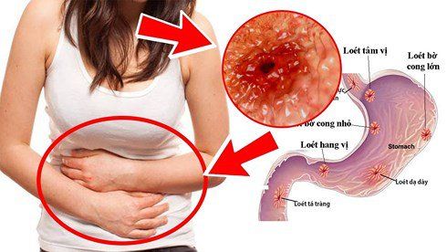 Gastrointestinal bleeding due to peptic ulcer