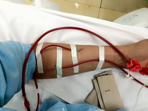 How long after surgery can patients with kidney failure undergo dialysis?