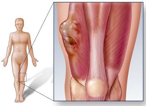 
Ung thư xương là tình trạng trong xương xuất hiện một khối u ác tính
