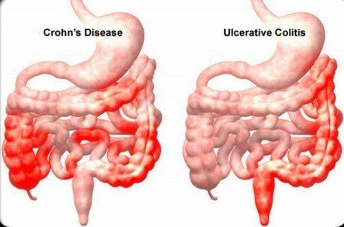 
Crohn là bệnh viêm mạn tính mô hạt của đường ống tiêu hóa, nhưng chủ yếu ở đoạn cuối ruột non
