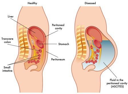 Treatment of peritoneal effusion