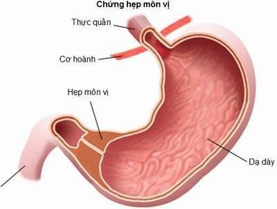 
Hẹp môn vị
