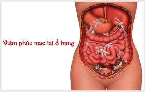 
Bị viêm phúc mạc là biến chứng nguy hiểm xảy ra khi ruột thừa bị vỡ
