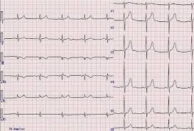 What does the electrocardiogram show?