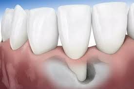 Trồng răng hiện đại (Implant): Giải pháp an toàn cho người bị mất răng