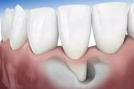 Modern dental implant (Implant): A safe solution for people who have lost teeth