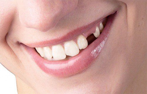 Bị tiêu xương sau khi làm cầu răng phải làm sao?