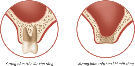 
Tiêu xương răng nguy hiểm như thế nào?
