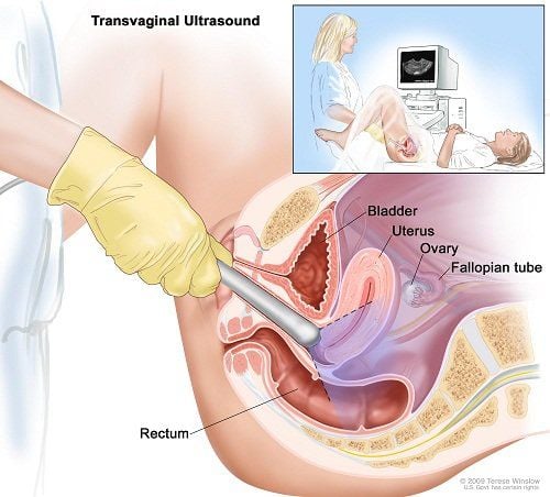 
Đối với siêu âm đầu dò âm đạo bệnh nhân phải đi tiểu hết để bàng quang không còn nước tiểu trước khi siêu âm
