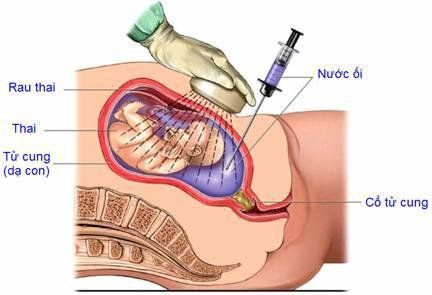 
Nếu nước ối tăng quá nhanh bạn có thể phải phẫu thuật, chọc ối để rút bớt nước ối.
