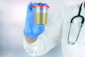 The meaning of ASC index in urine test