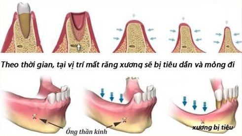 
Quá trình tiêu xương hàm sau khi mất răng
