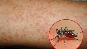 Dengue fever in children is more dangerous than in adults