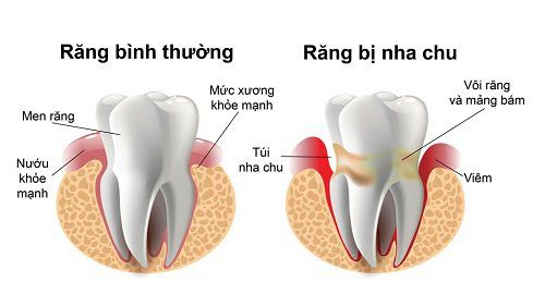 Bệnh viêm nha chu có lây không?