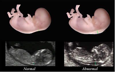 What to do if the nuchal translucency measurement result is abnormal