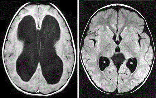 
Hình ảnh chụp MRI não úng thuỷ
