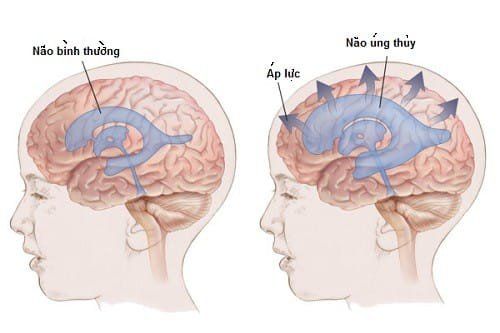 Is ventricular dilatation dangerous?