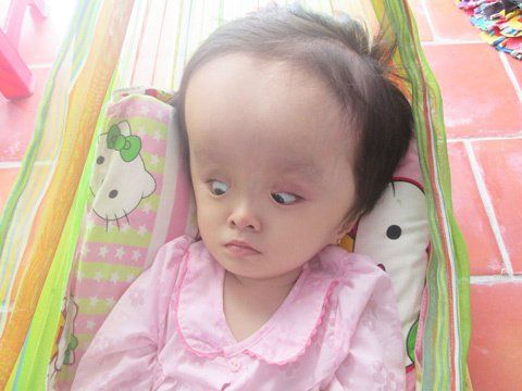 Treatment of hydrocephalus