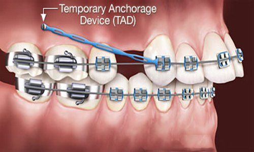 Các kiểu răng vẩu thường gặp