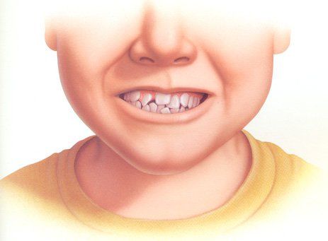 How to deal with misaligned teeth?