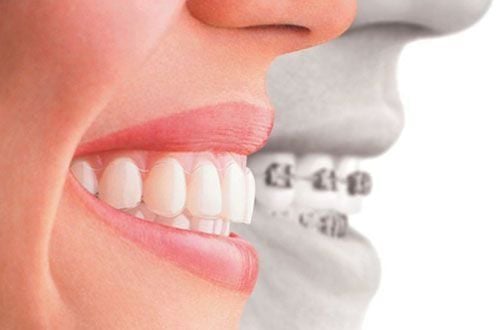 Common types of malocclusion