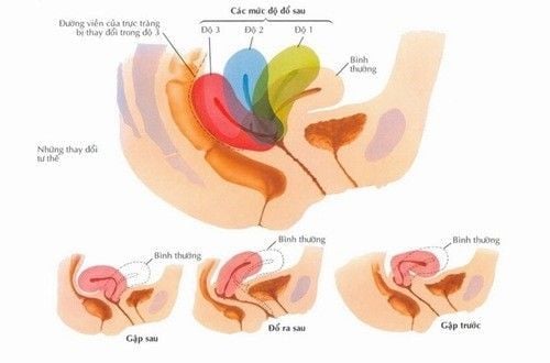 
Hình ảnh sa tử cung theo từng cấp độ 1, 2, 3
