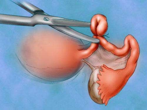 Complete answers about hysterectomy