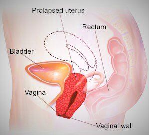 Uterine prolapse: Who is susceptible?